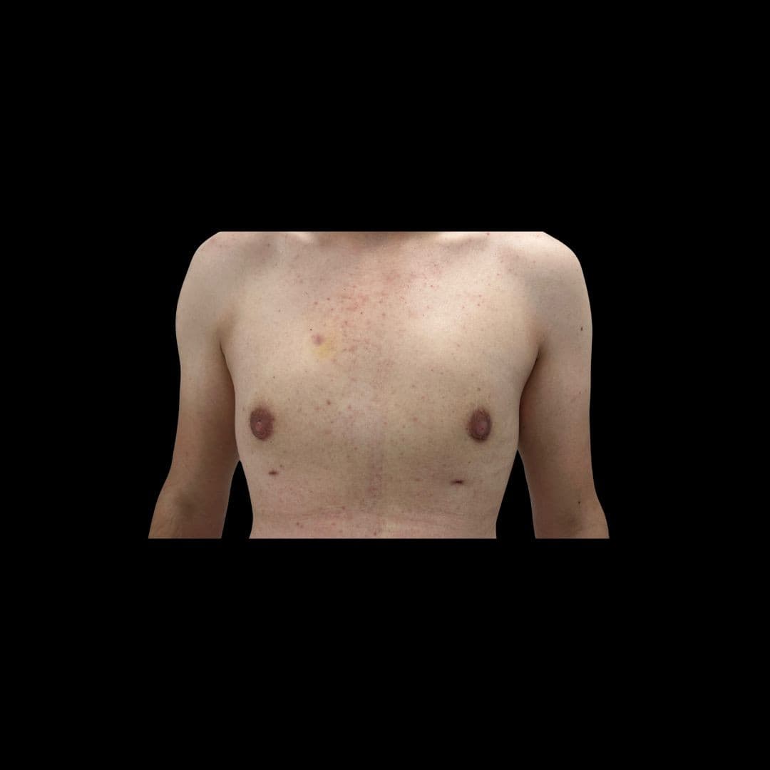 Po zabiegu Ginekomastia