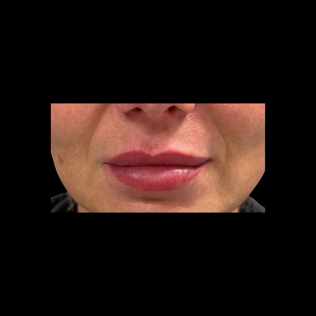 Przed zabiegiem Lip Lift
