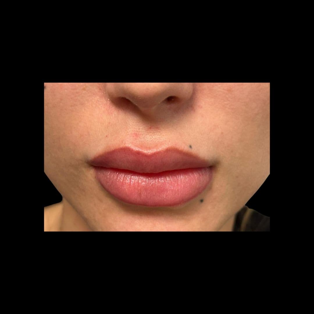 Przed zabiegiem Lip Lift