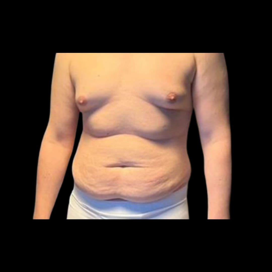 Przed zabiegiem Liposukcja - przykład 1