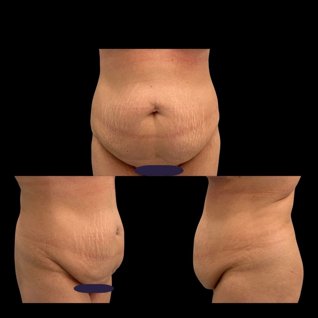 Przed zabiegiem Mommy make-over - przykład 3