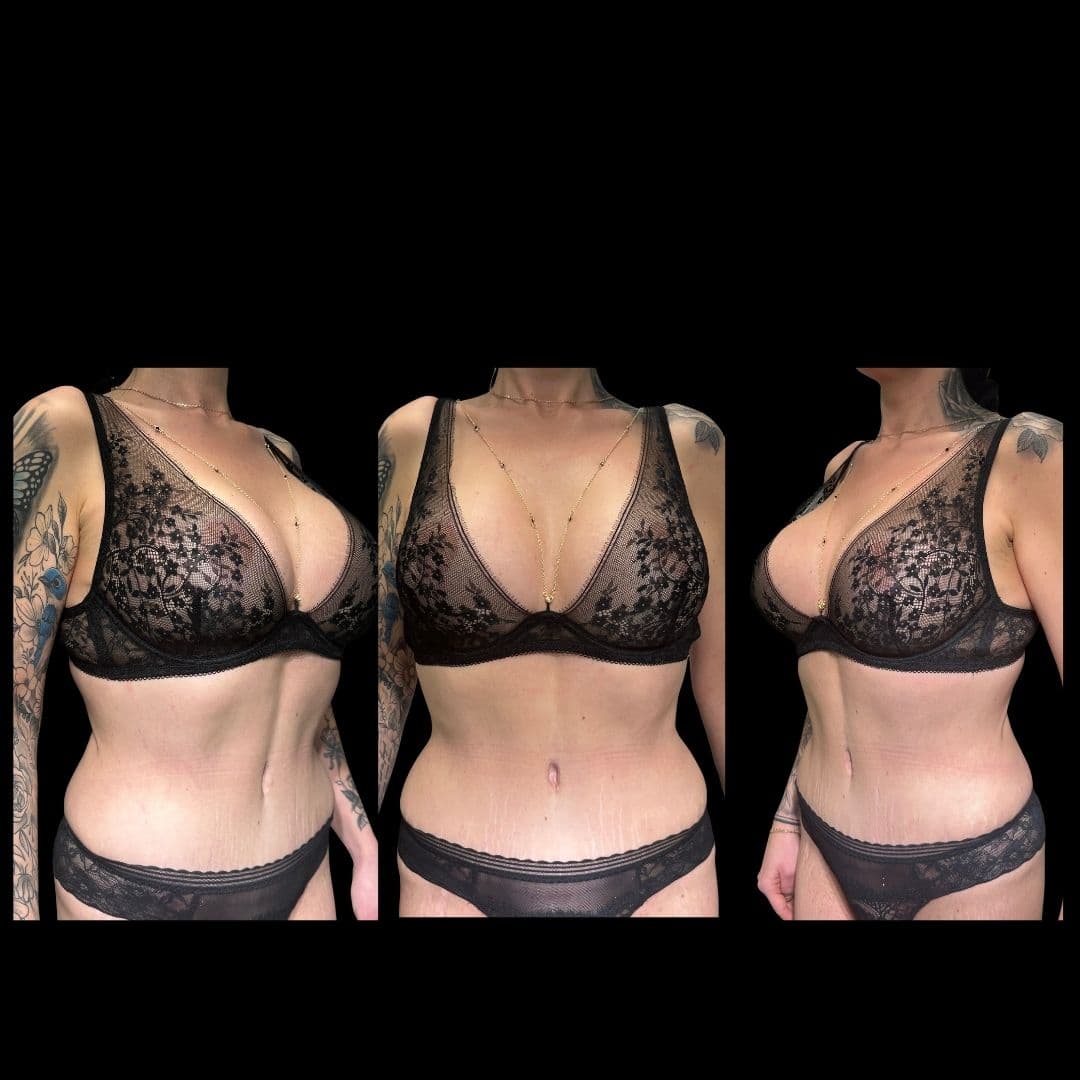 Po zabiegu Mommy make-over - przykład 3