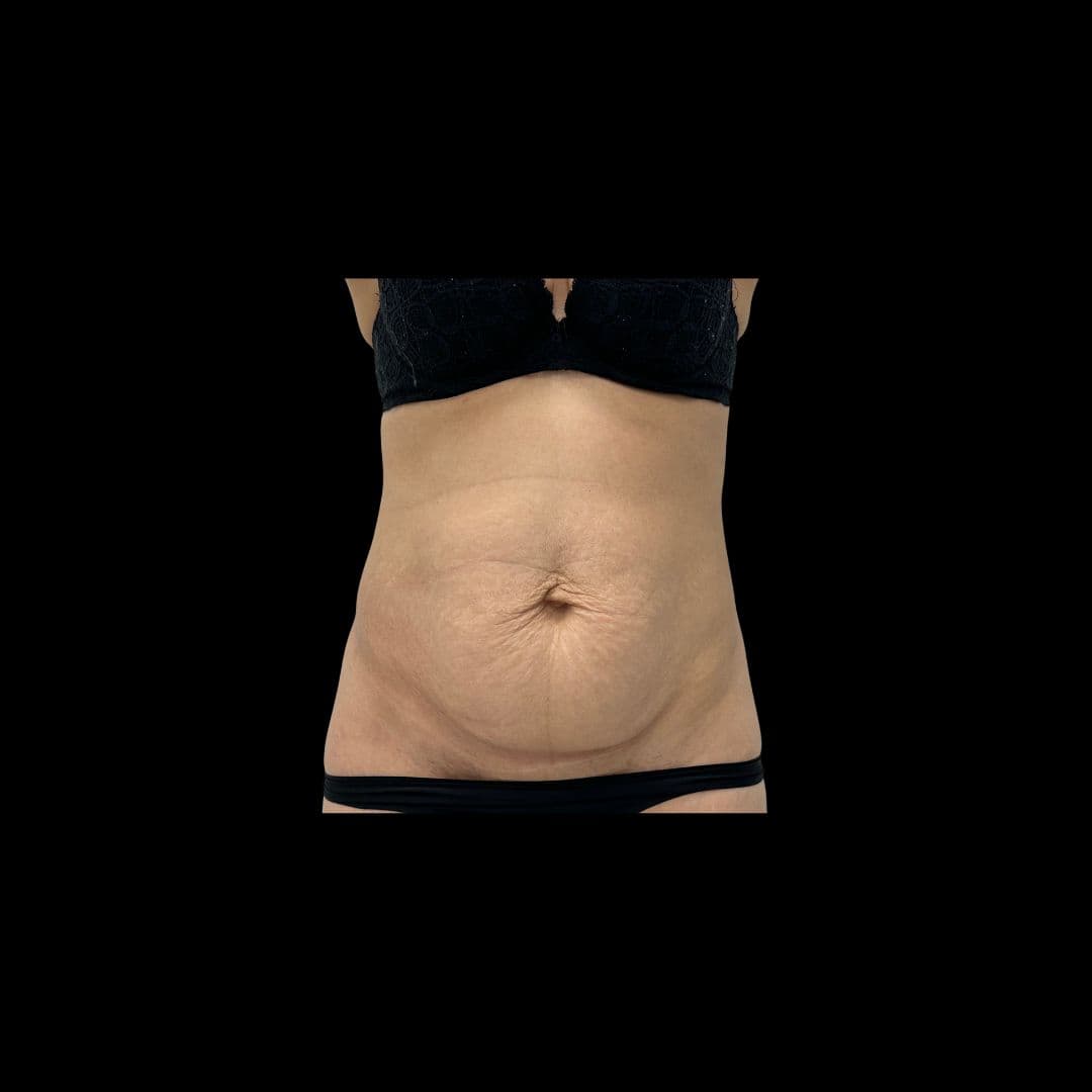 Przed zabiegiem Plastyka brzucha - przykład 3