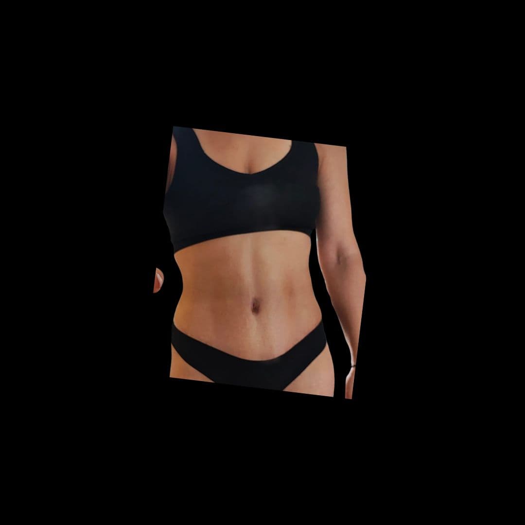 Po zabiegu Plastyka brzucha - przykład 3