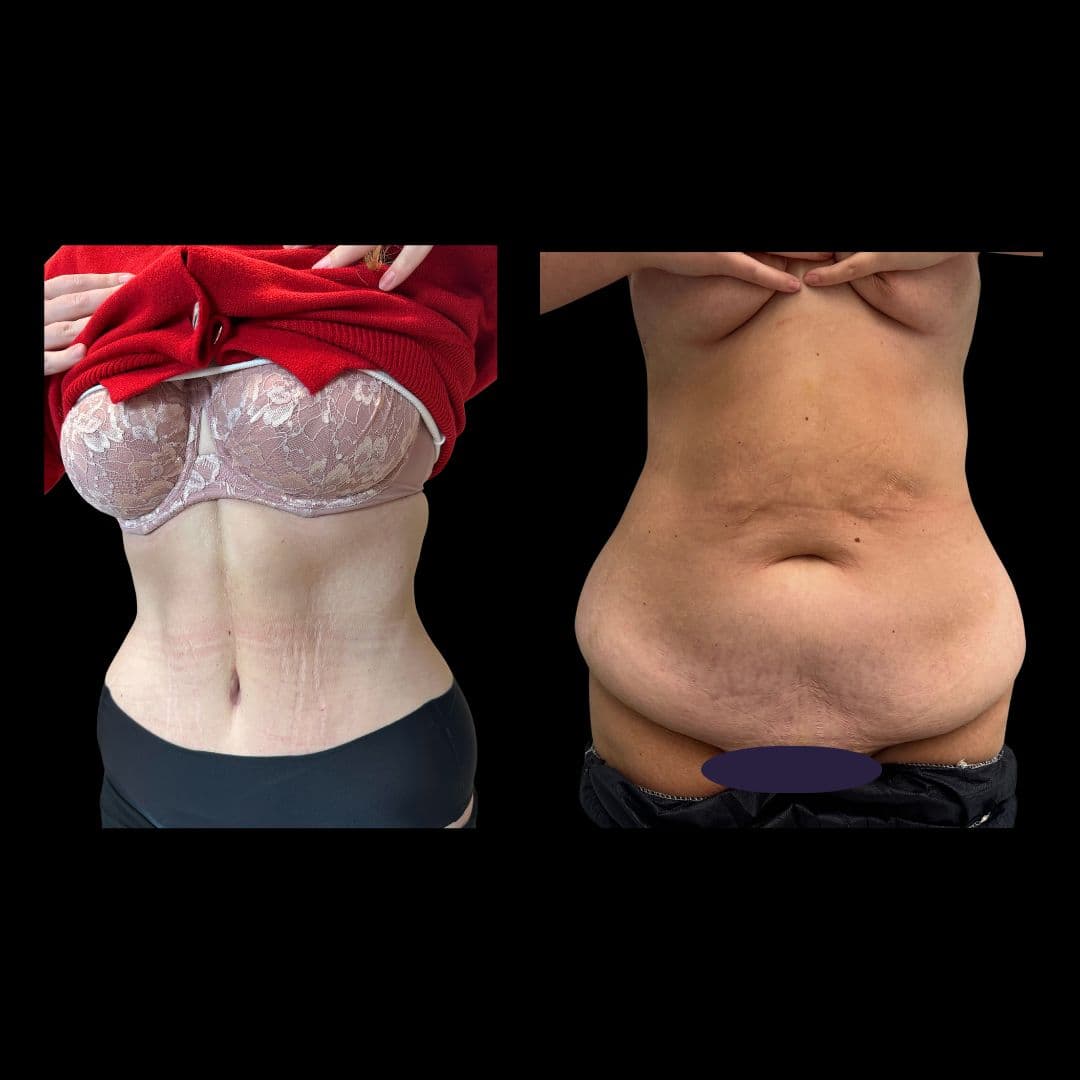 Przed zabiegiem Plastyka brzucha - przykład 2