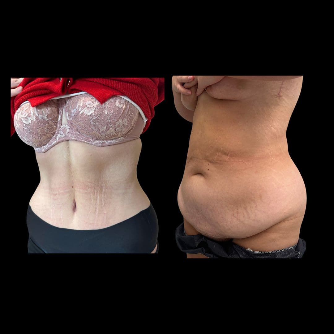 Po zabiegu Plastyka brzucha - przykład 2