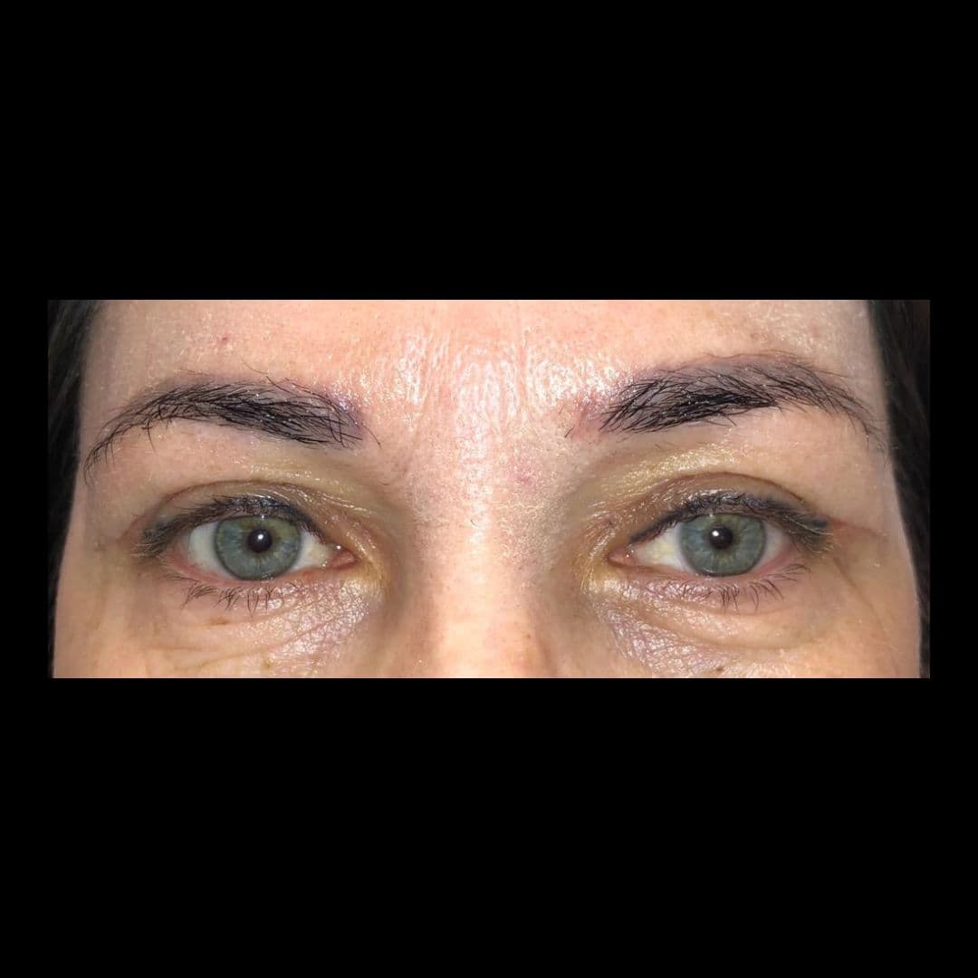 Po zabiegu Powieki górne