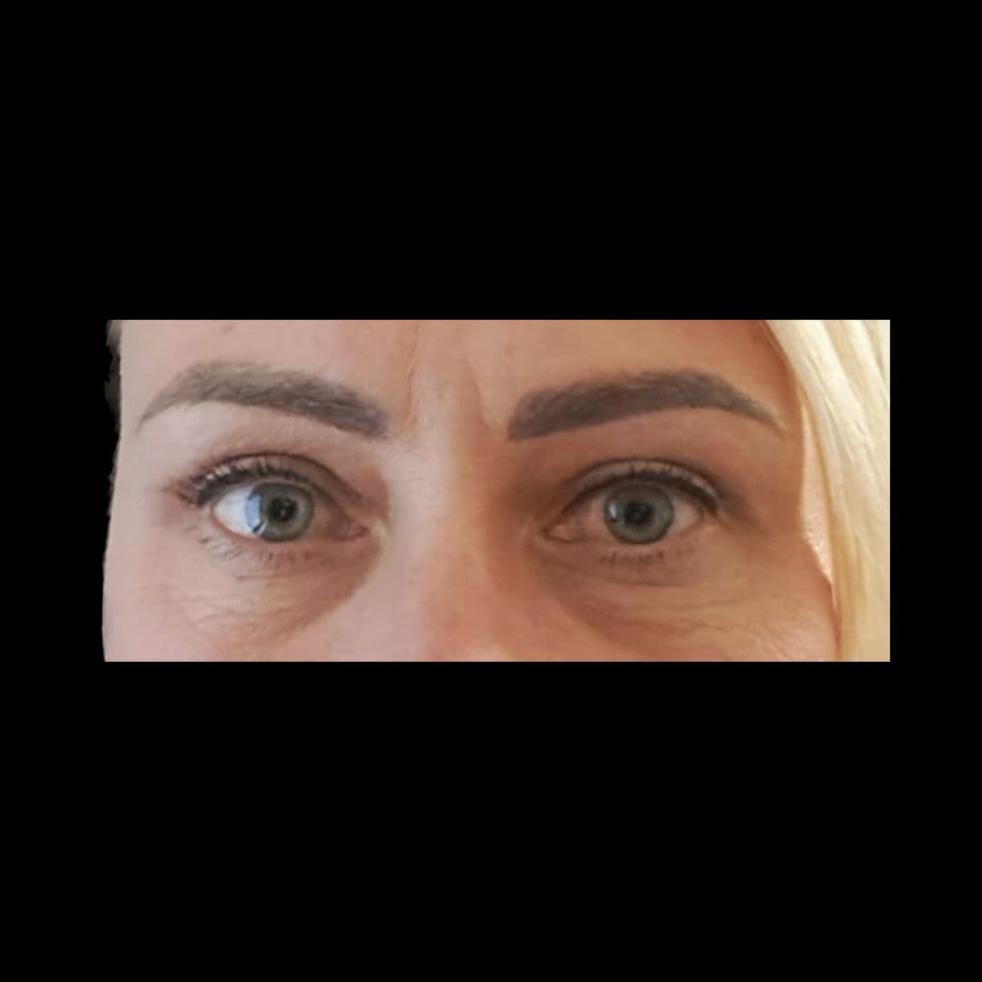 Po zabiegu Powieki górne