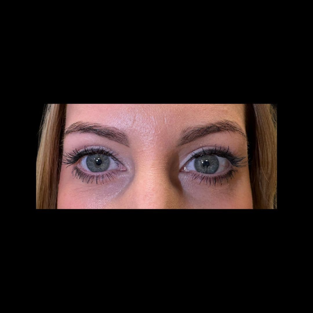 Po zabiegu Powieki górne