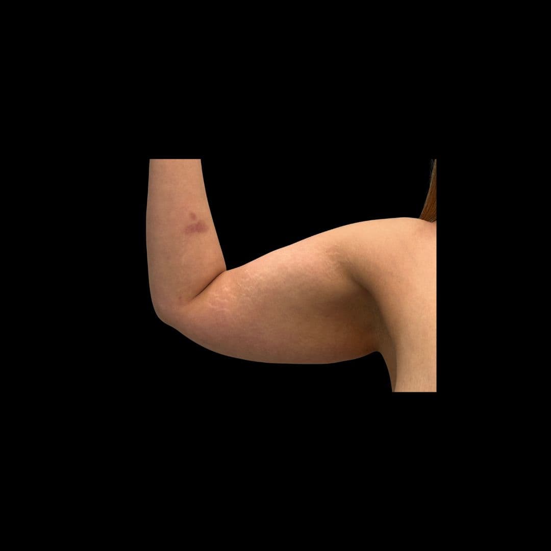 Przed zabiegiem Lift ramion - przykład 2