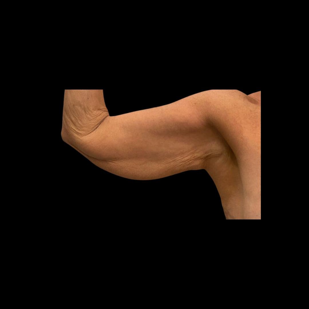 Przed zabiegiem Lift ramion - przykład 1