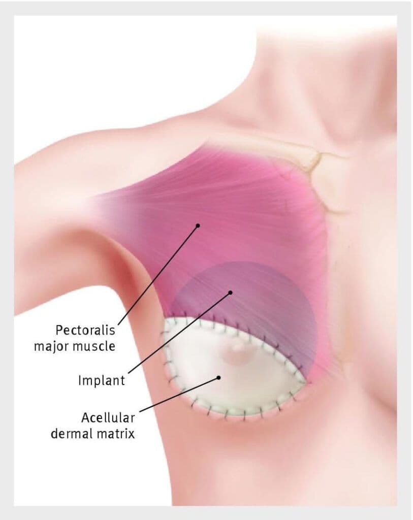 Budowa piersi - miejsce implantu